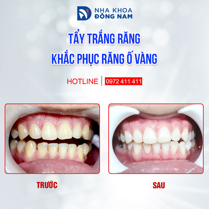 Tẩy trắng răng không ê buốt