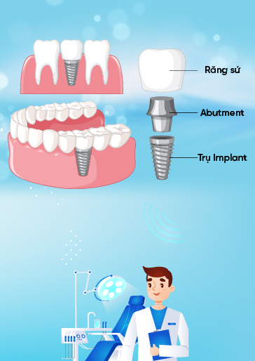 dịch vụ implant