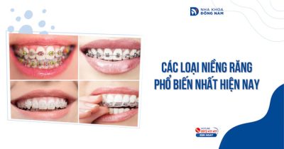 Các loại niềng răng phổ biến nhất hiện nay