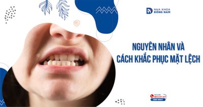 Nguyên nhân và cách khắc phục mặt lệch