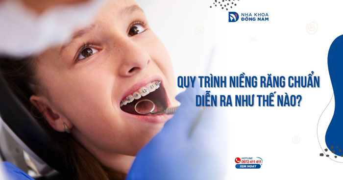 Quy trình niềng răng chuẩn diễn ra như thế nào?