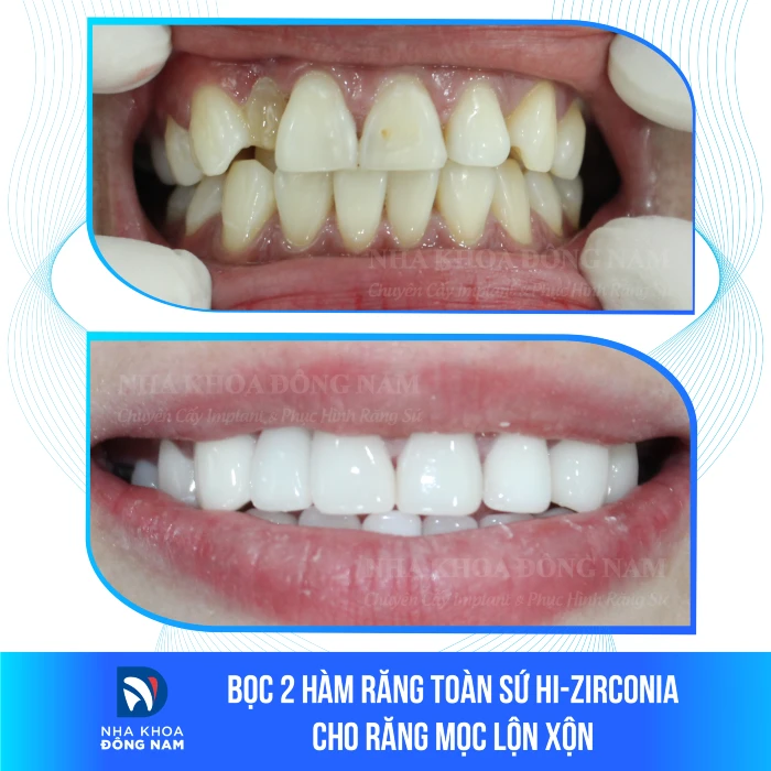 Hình ảnh trước và sau điều trị phục hình răng sứ Hi-Zirconia. Trước điều trị, răng của bệnh nhân gặp vấn đề về form và màu sắc, đặc biệt là răng số 12 mọc lệch trong. Sau quá trình điều trị kéo dài 16 ngày, với các bước điều trị tủy, cắt nướu và phục hình sứ cho 19 đơn vị răng, kết quả là các răng đã được phục hồi với hình thể hoàn chỉnh và màu sắc tự nhiên. Khách hàng cảm thấy tự tin hơn với nụ cười mới và hài lòng với chức năng ăn nhai cải thiện.