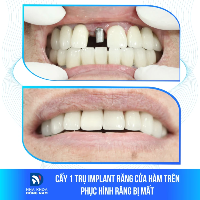 Trước và sau điều trị của khách hàng với tình trạng gãy răng cửa R11. Trước khi điều trị, răng bị gãy sâu dưới nướu và phục hình sứ cũ đã bị rơi. Sau quá trình điều trị bao gồm cấy ghép Implant Hàn Quốc và phục hình sứ Titan, răng cửa R11 đã được phục hồi hoàn toàn, cải thiện chức năng ăn nhai và thẩm mỹ hài hòa với màu sắc tự nhiên, mang lại sự tự tin cho khách hàng trong giao tiếp và sinh hoạt hàng ngày.