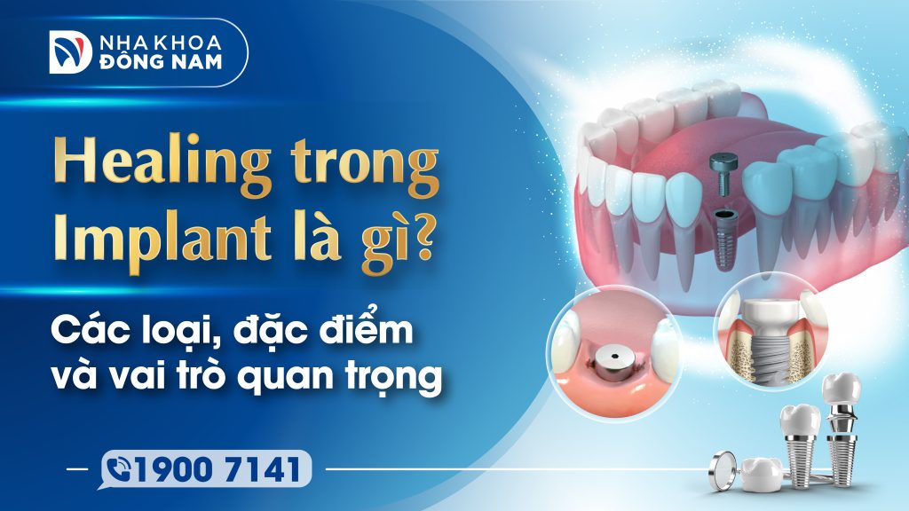 Healing trong Implant là gì? Các loại, đặc điểm và vai trò quan trọng