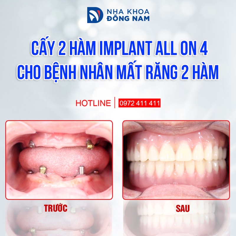 All-on-4 giúp phục hồi chức năng ăn nhai và thẩm mỹ vượt trội