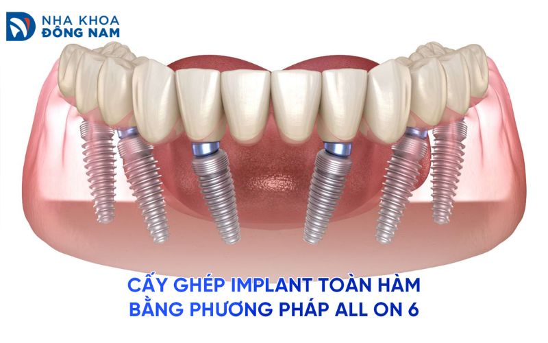 Cấy ghép implant toàn hàm