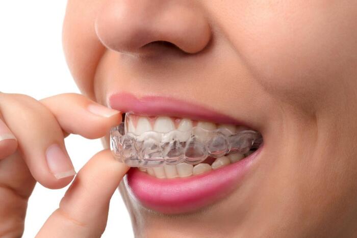 Sau khi tháo mắc cài cần đeo hàm duy trì ít nhất 6 tháng