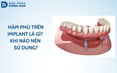 hàm phủ trên implant