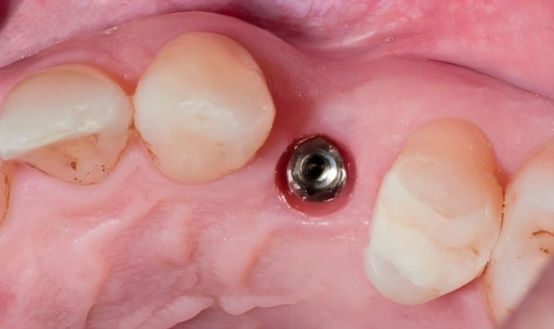 Healing Abutment đóng vai trò quan trọng khi cấy ghép Implant
