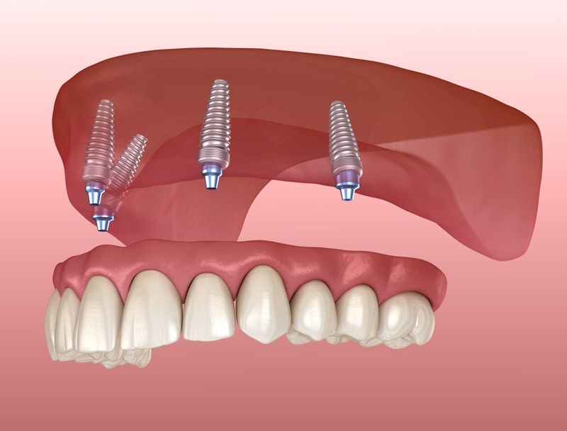 Kỹ thuật cấy ghép Implant All-on-4 là đặt 4 trụ Implant vào xương hàm