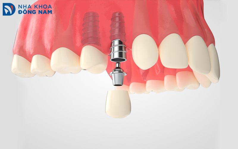Cấy ghép implant tức thì phù hợp với trường hợp mất răng đơn lẻ