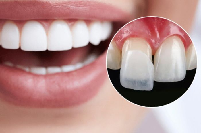 Có nhiều phương pháp phục hình răng cần mài răng