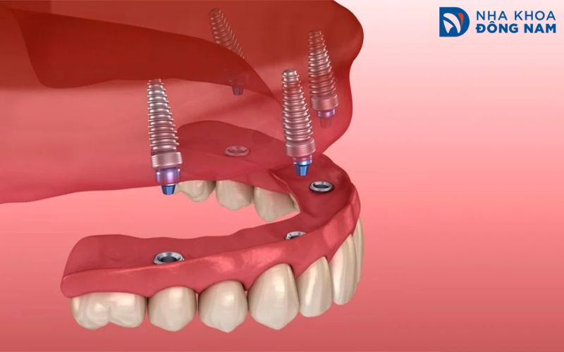 Ưu điểm của hàm phủ trên Implant