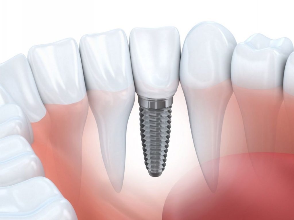 Cầu răng sứ và Implant