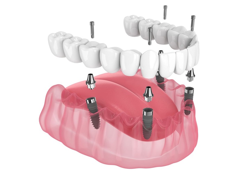 Phương pháp phục hình All-on-4 cố định