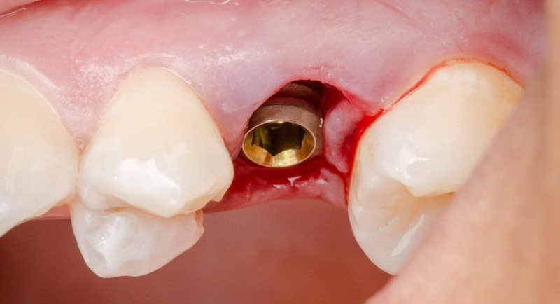 Quy trình đặt Healing Abutment nhanh chóng, nhẹ nhàng