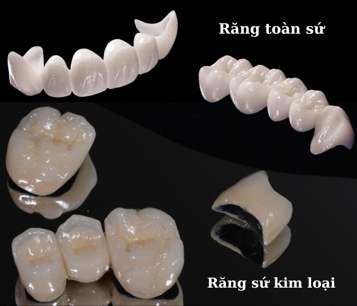 Sự khác biệt giữa răng sứ kim loại và răng toàn sứ
