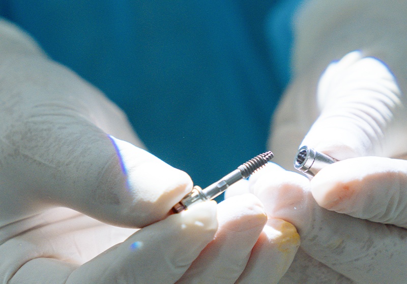 Tiến hành đặt trụ Implant vào xương hàm