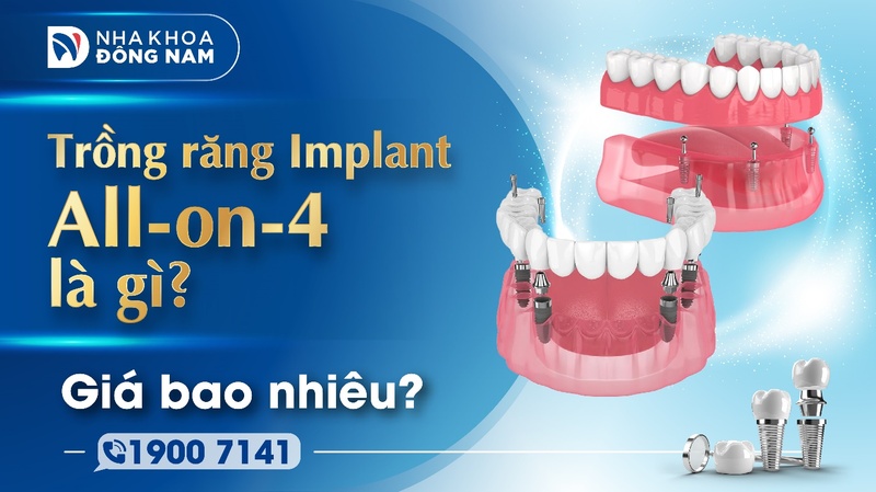 Trồng răng Implant All-on-4 là gì? Giá bao nhiêu?