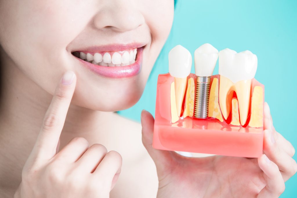 Trồng răng Implant có bị hôi miệng không