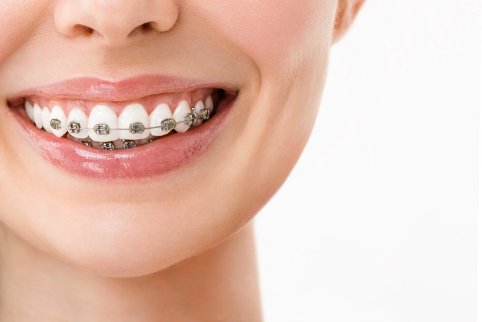 Nên ưu tiên niềng răng trước khi cấy ghép răng Implant
