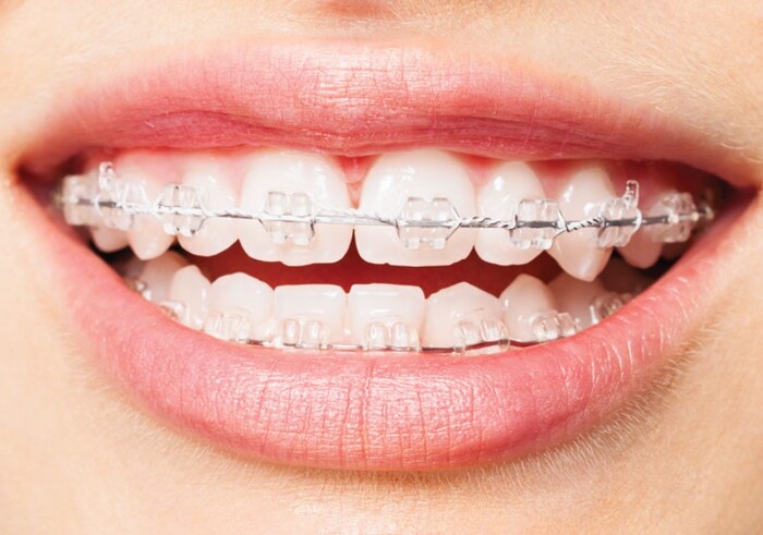 Trồng răng Implant có niềng răng được không? 