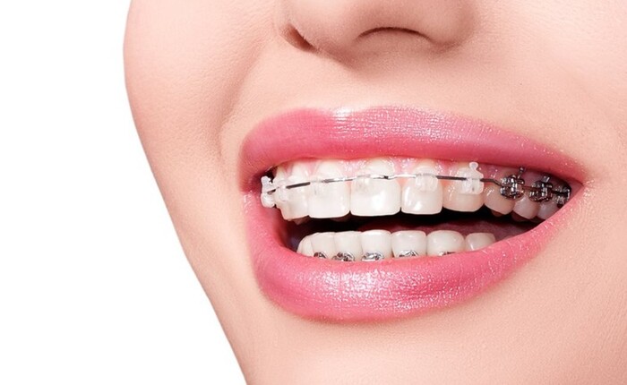 trồng răng Implant có niềng răng được không