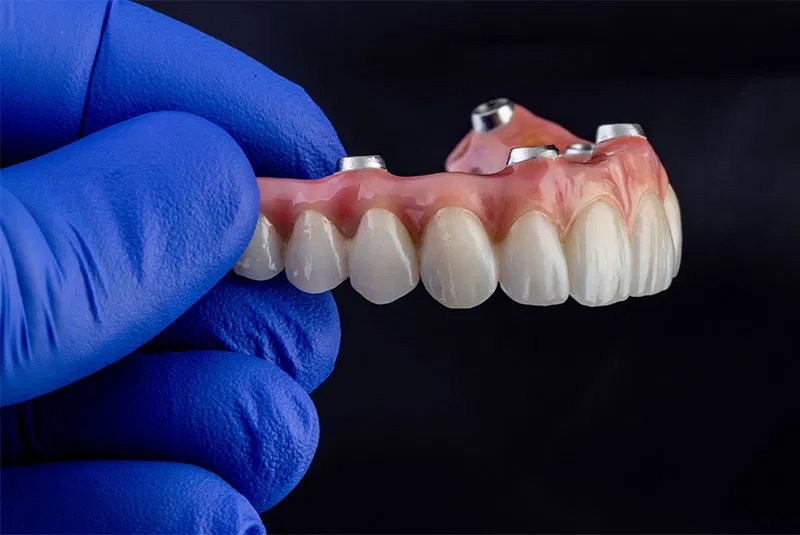 Trồng răng Implant toàn hàm All-on-4 là kỹ thuật đòi hỏi chuyên môn cao