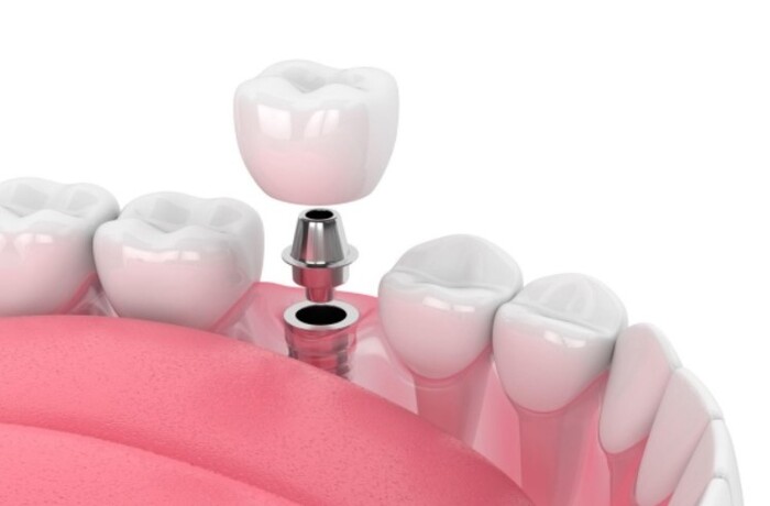 ưu nhược điểm của trồng răng Implant