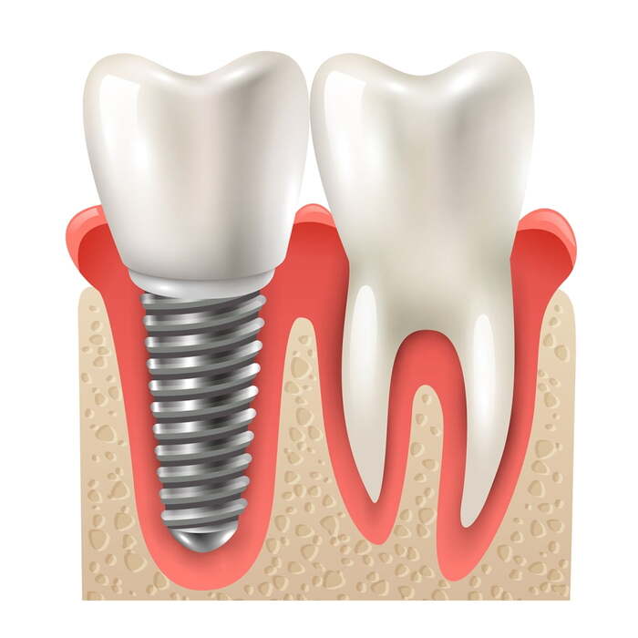 Trồng răng Implant hỗ trợ ngăn ngừa tình trạng tiêu xương hàm