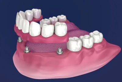 làm răng giả tháo lắp trên implant