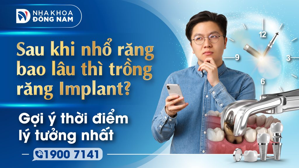 Sau khi nhổ răng bao lâu thì trồng răng Implant? Gợi ý thời điểm lý tưởng nhất
