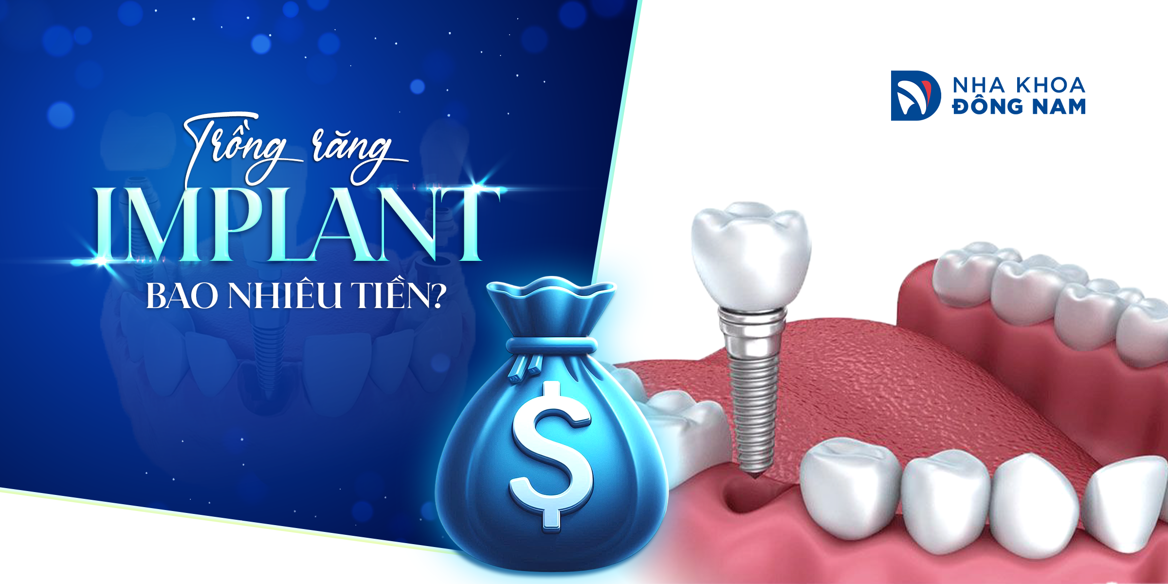 Trồng răng Implant bao nhiêu tiền