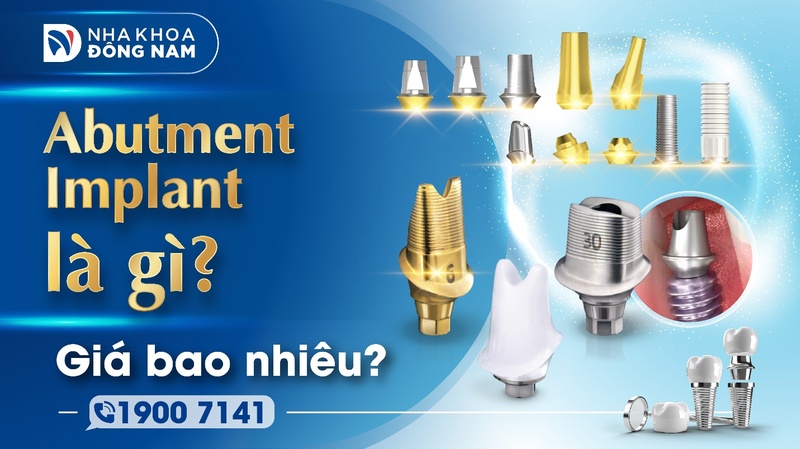 Abutment Implant là gì và chi phí thực hiện