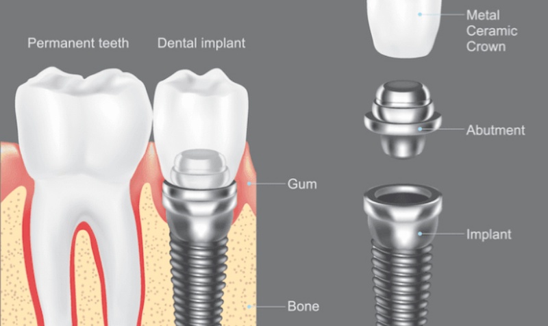 Abutment vừa giữ vai trò thẩm mỹ và đảm bảo ổn định chức năng nhai