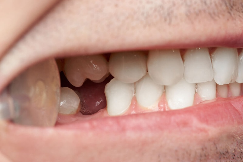 Bệnh lý răng miệng có thể dẫn tới mất răng hàng loạt