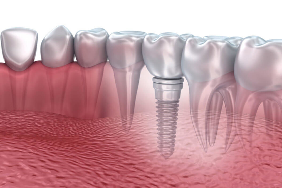 Sau 3 tháng nhổ răng là thời điểm khá thích hợp để đặt trụ Implant