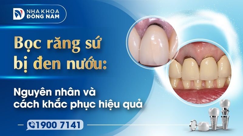 Bọc răng sứ bị đen nướu do đâu? Cách khắc phục hiệu quả