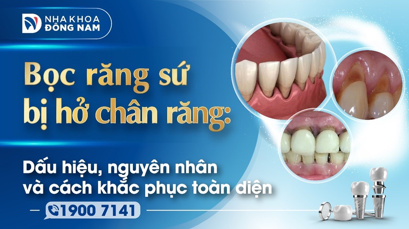 Bọc răng sứ bị hở chân răng Dấu hiệu, nguyên nhân và cách khắc phục toàn diện