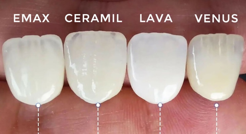 Các loại răng sứ toàn sứ phổ biến tại nha khoa