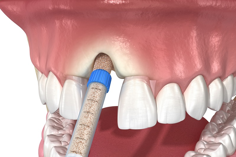 Hiện có đa dạng các phương pháp ghép xương