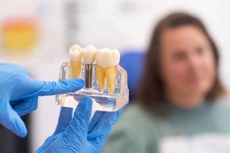 Các yếu tố giúp kết quả trồng răng Implant tối ưu hơn