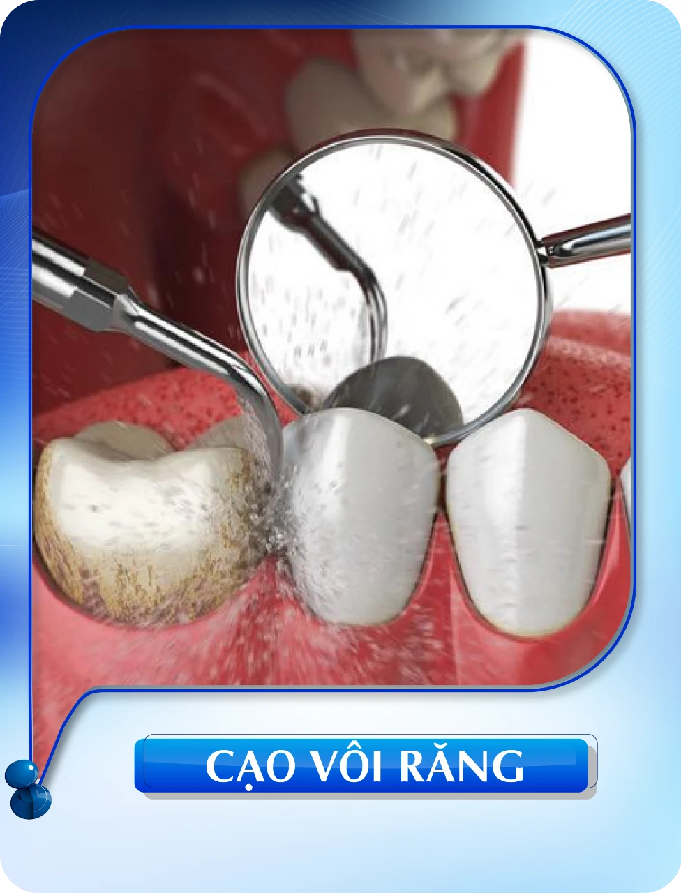 Cạo vôi răng