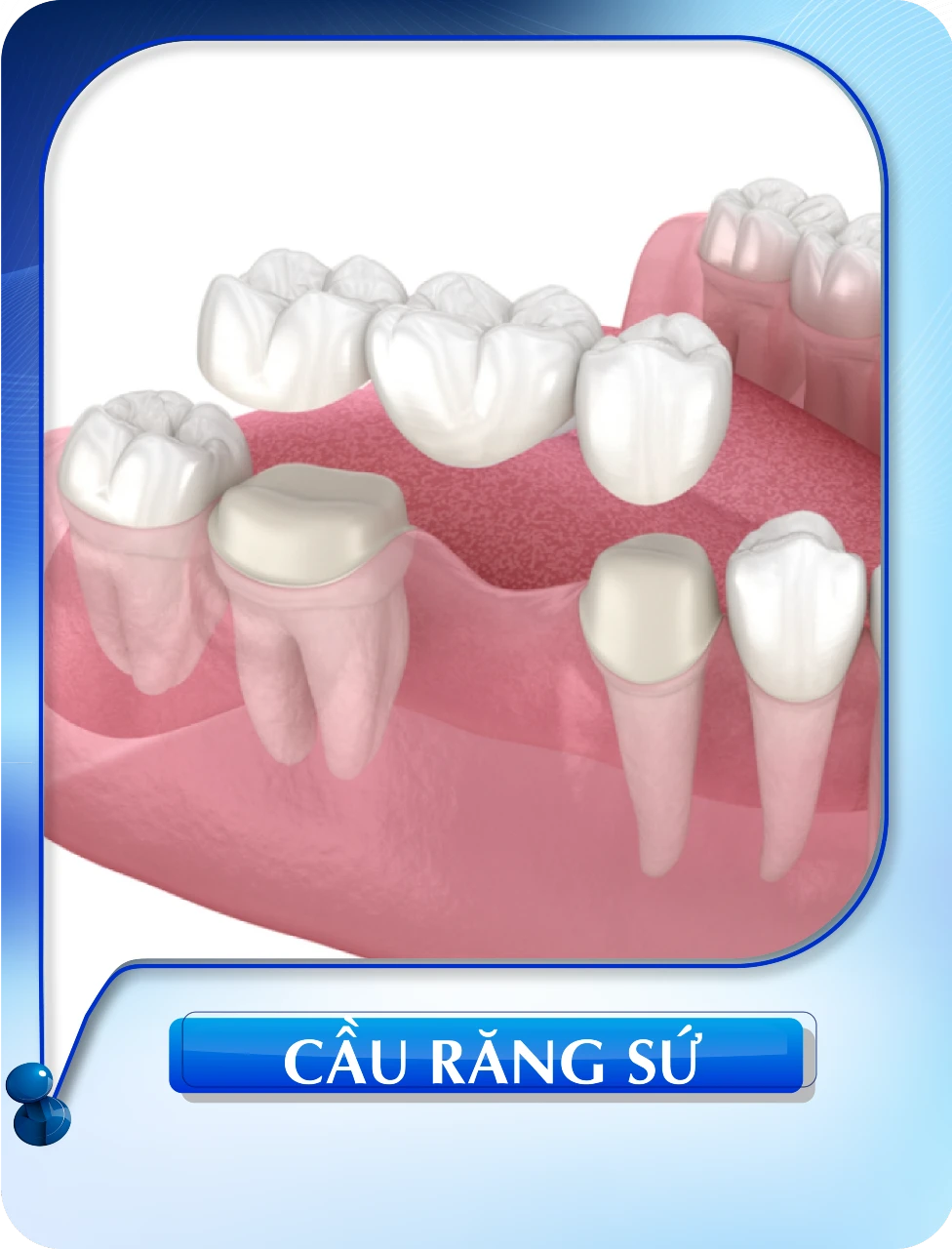 Cầu răng sứ