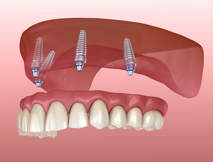 Cấy ghép Implant All On 4 cho trường hợp mất răng toàn hàm