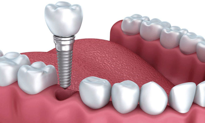 Cấy ghép Implant đơn lẻ