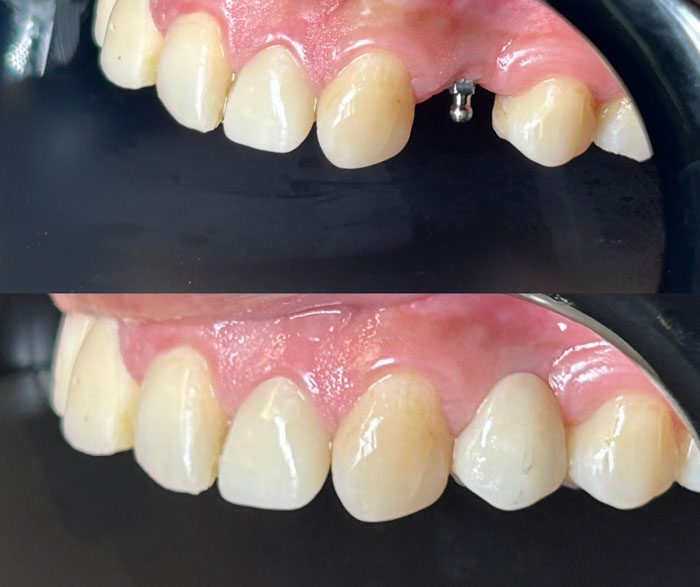 Cấy ghép Implant là giải pháp phục hình răng mất toàn diện