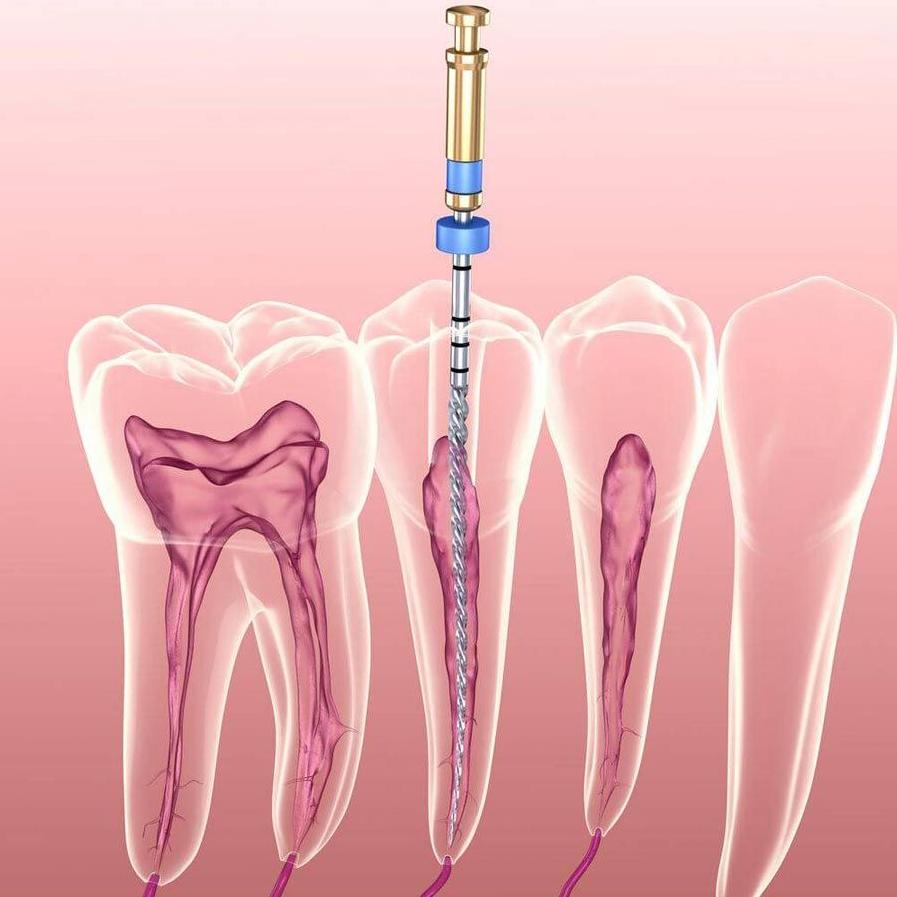 Niềng răng sau bọc sứ chỉ được thực hiện khi răng chưa lấy tủy