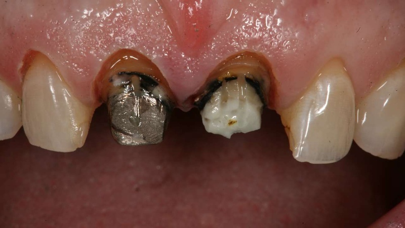 Cùi răng bị viêm nhiễm có thể dẫn tới mất răng