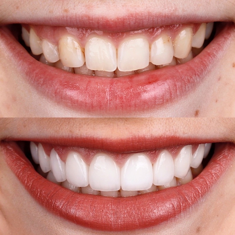Dán răng thỏ Veneer